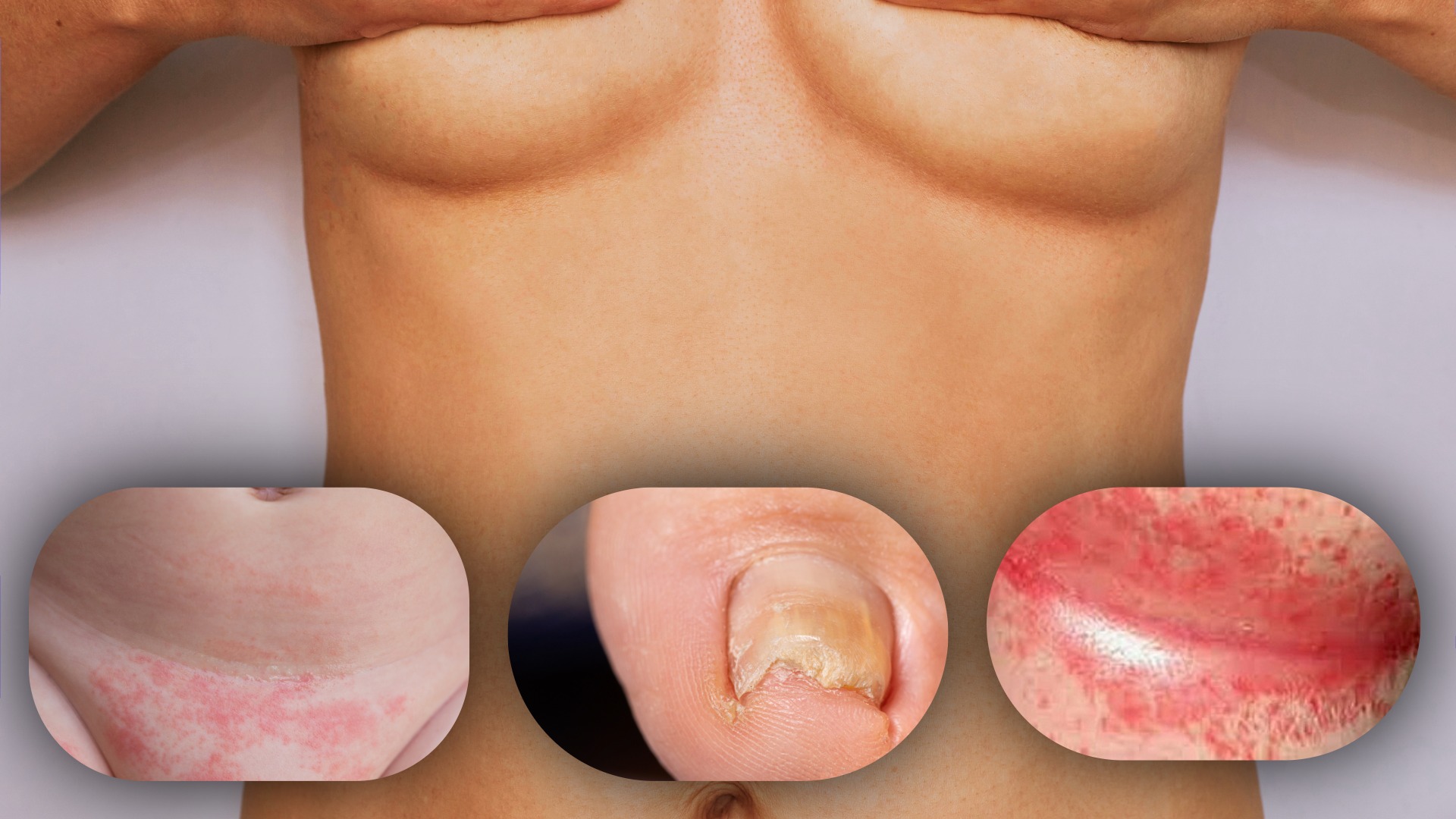 Candidiasis en la piel