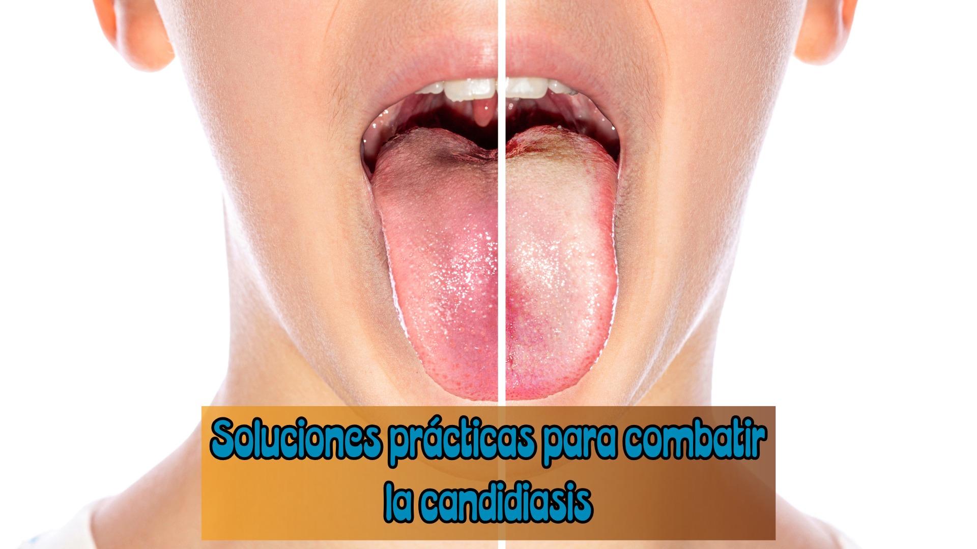 Lengua blanca por la Cándida