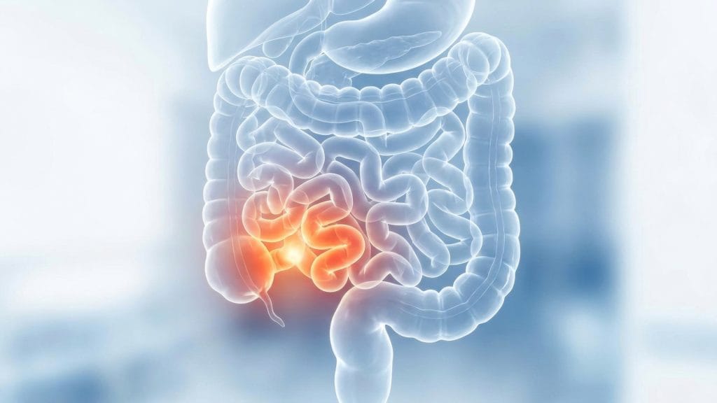 Sindrome de Intestino Irritable